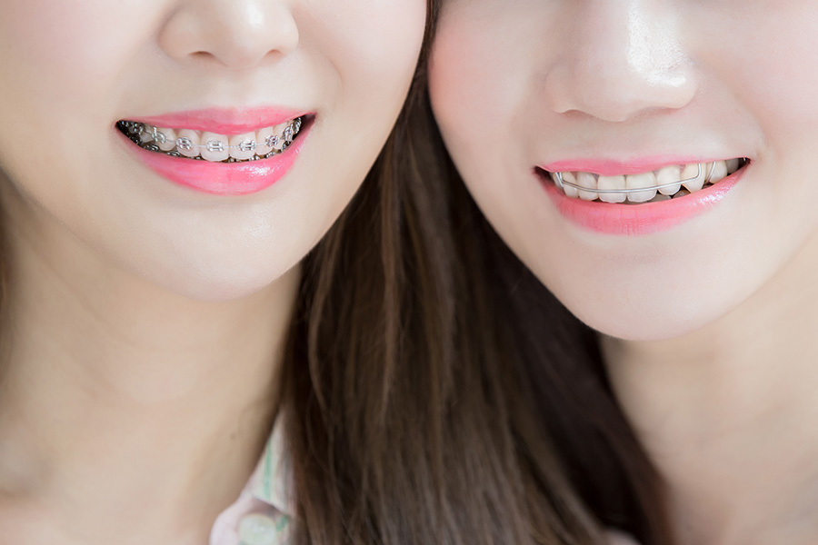 ブラケットとワイヤー